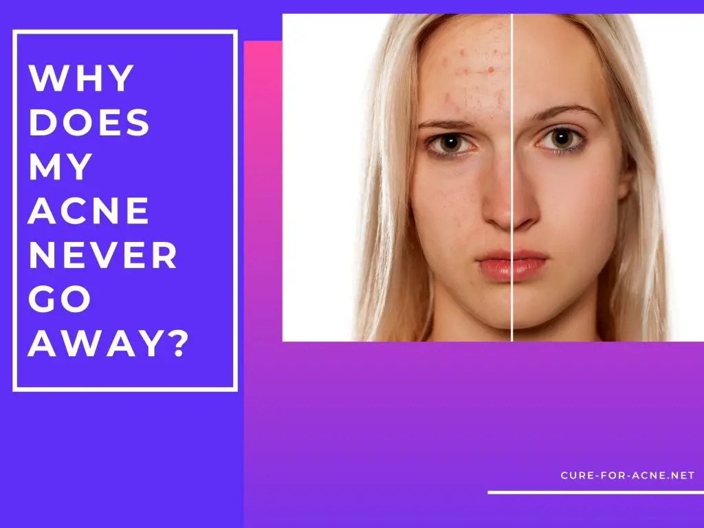 Why Won't My Acne Go Away? - Cure For Acne