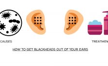 How to Get Blackheads Out of Your Ears