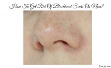 How To Get Rid Of Blackhead Scars On Nose