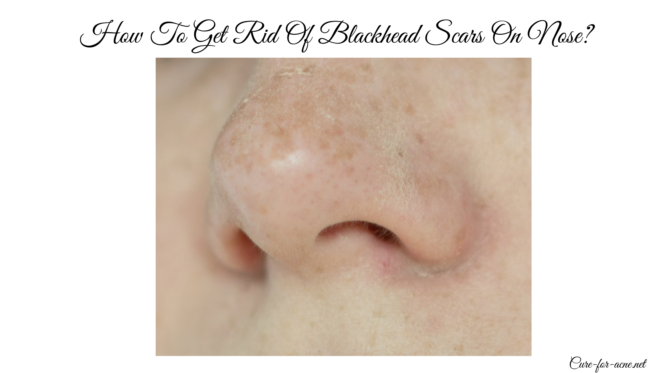 How To Get Rid Of Blackhead Scars On Nose