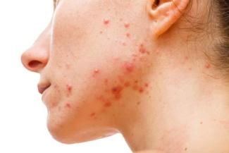Can Tacrolimus Be Used For Acne?