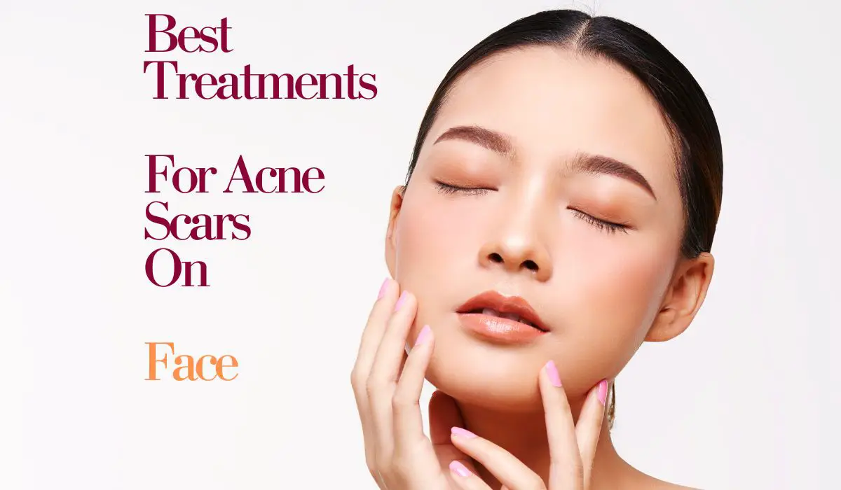 Best Treatment For Acne Scars On Face
