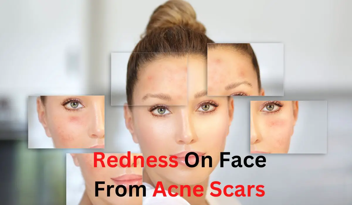 How To Reduce Redness On Face From Acne Scars?